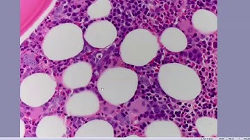 Approach to MDS in a Patient with Anemia