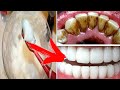 отбеливание зубов в домашних условиях за 2 минуты / обзор для естественного отбеливания желтых зубов