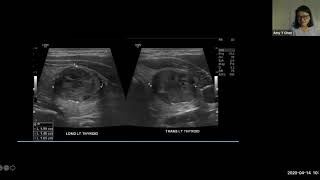 Thyroid case presentations - Dr. Amy Chen screenshot 2