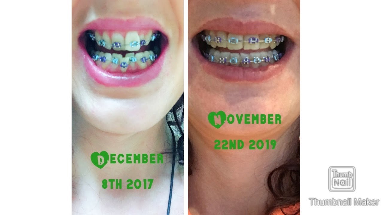 Super update, double jaw surgery, overbite, gummy smile YouTube