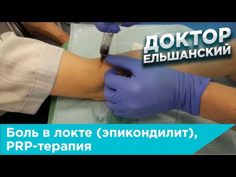 Видео: Епикондилит на лакътя (лакътна става) - видове, симптоми, съвременни методи на лечение