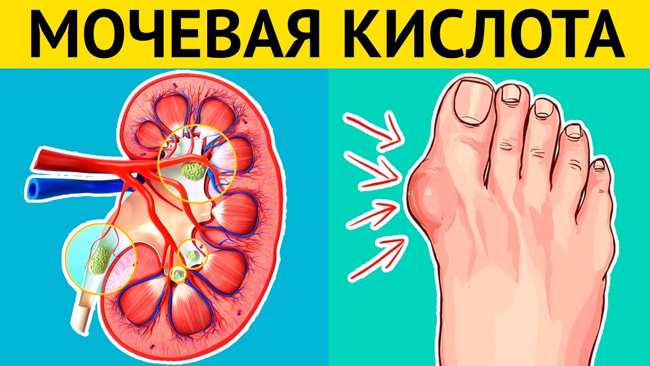 Последствия повышенной мочевой кислоты