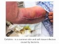 Cellulitis - a patient education video