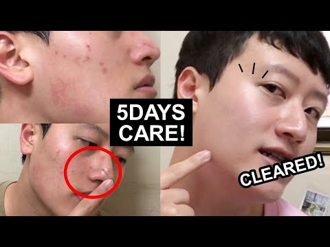 How I Cleared Acne Scars/Irritation with Korean Skincare in 5 days