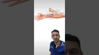 A free flap reconstruction of upper lip using a Radial artery forearm flap.