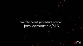 Prophylactic Laparoscopic Bilateral Gonadectomy For Complete Androgen Insensitivity Syndrome