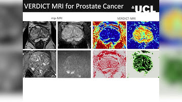 Computational modelling for non-invasive cancer microstructure estimates with MRI