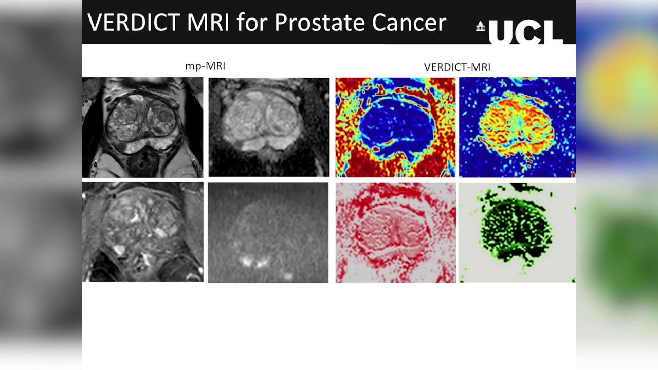 Computational modelling for non-invasive cancer microstructure estimates with MRI