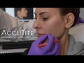 Accutite skin tightening  facial contouring with dr kian karimi