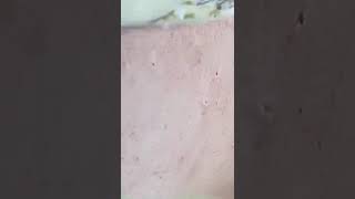 #TextBlackheads Removal  #Text Relax | satisfying   With Din Spa 2025 🌟 🐷 😍