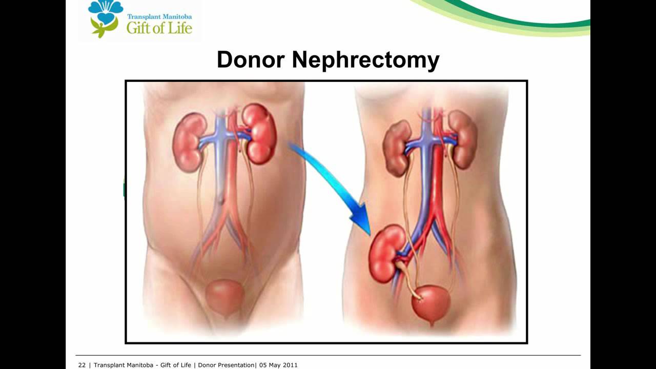 Living kidney donor program (Manitoba) YouTube