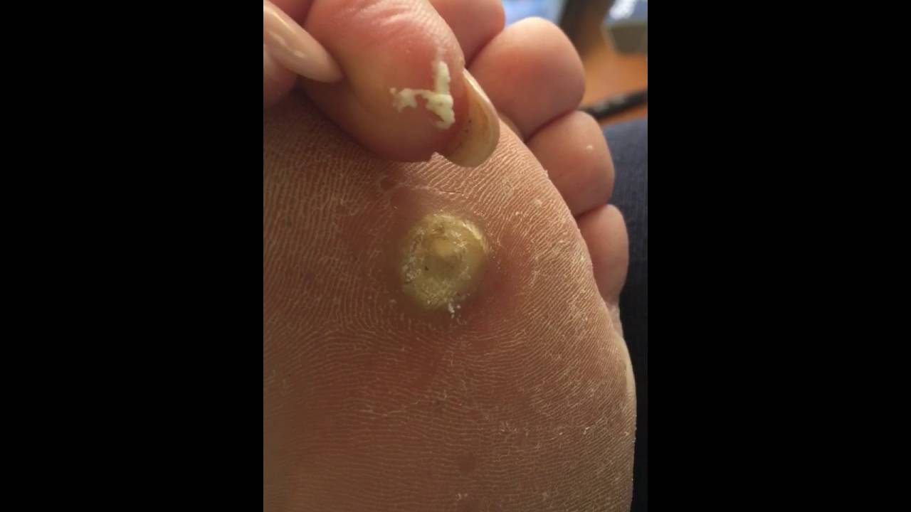 Infected Plantar Wart YouTube
