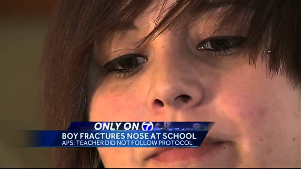 Student Fractured Nose Update