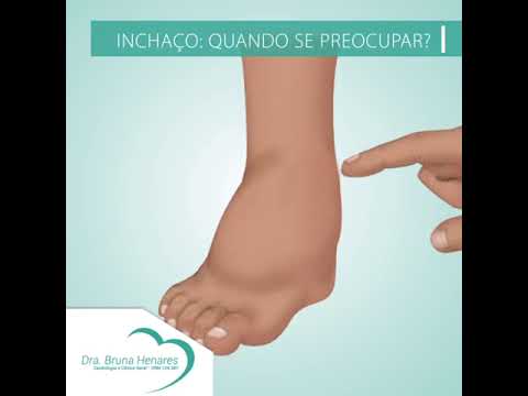 Vídeo: 12 maneiras de curar ou aliviar o edema