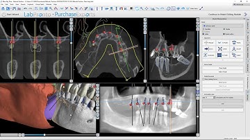 Orienting Segmentation Data from Diagnocat AI in a Blue Sky Plan Project