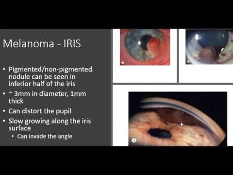Ocular tumours