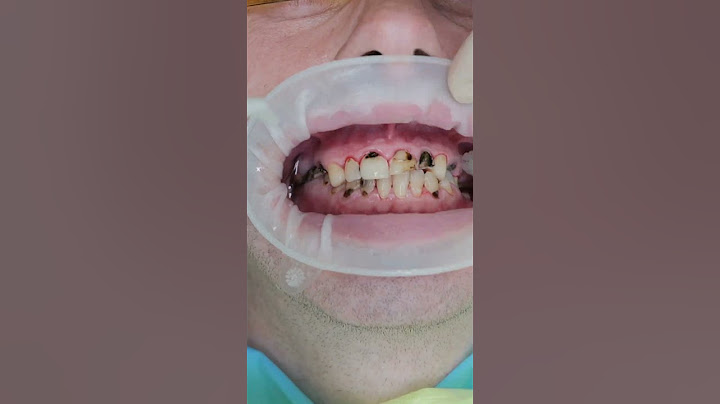 Transform Your Smile in Prague #shorts #dentist #dental #veneers #short