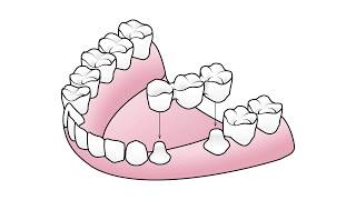 FAQ - What is the better option when replacing a missing tooth: a bridge or an implant?