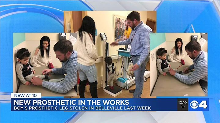 3-year-old who had prosthetic leg stolen gets priority fitting for a replacement
