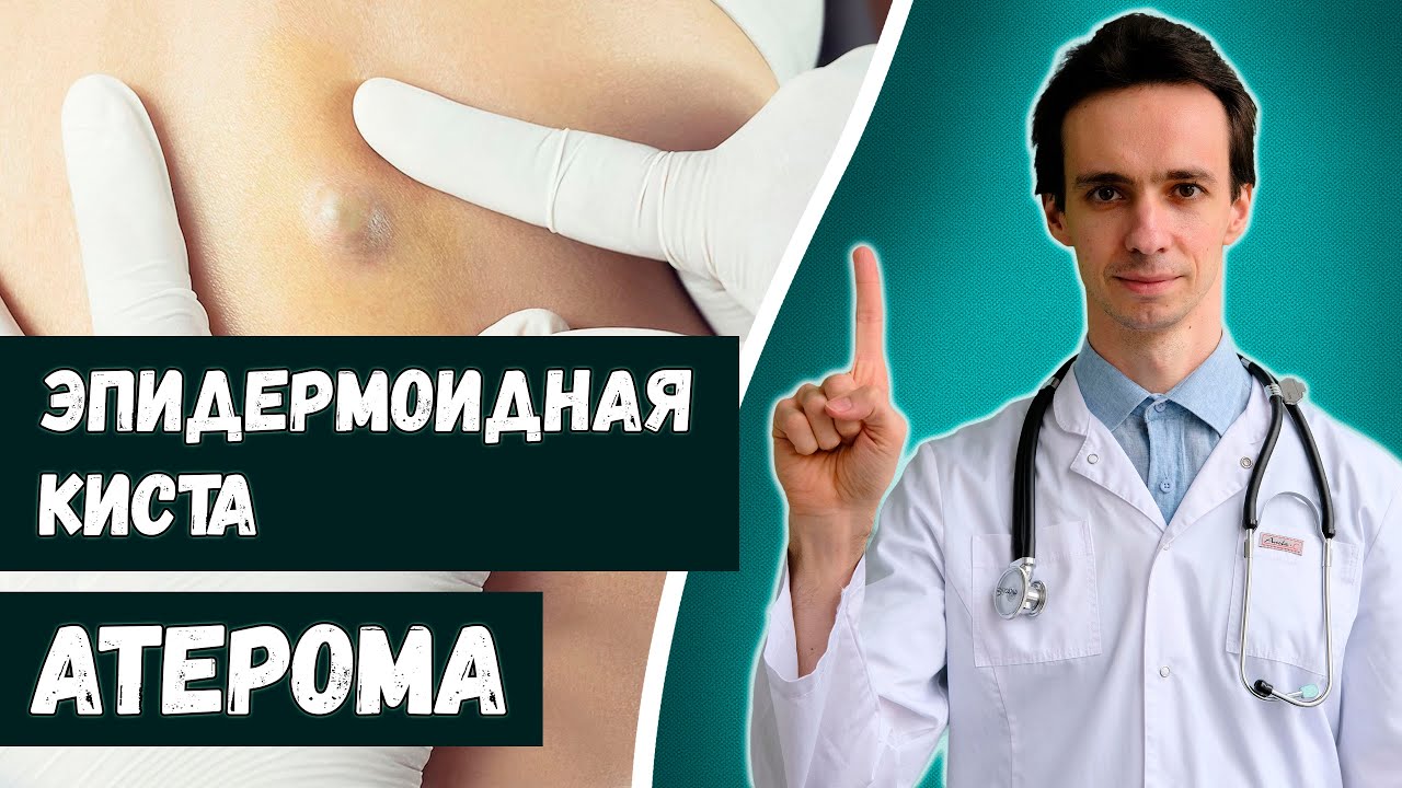 Атерома (киста сальной железы): краткая информация 🚨 Лечение. 2022 ...