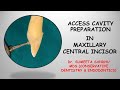 Incisor access opening| Incisor access cavity RCT| Easy endodontics for maxillary incisor