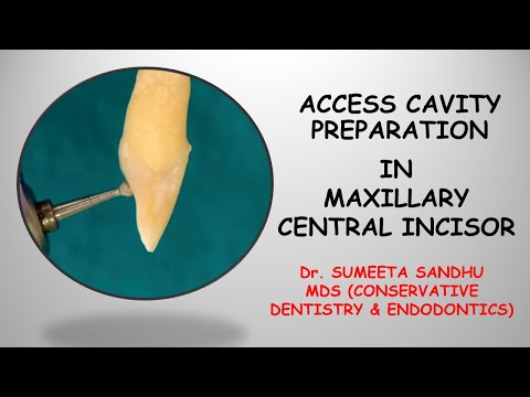 Incisor access opening| Incisor access cavity RCT| Easy endodontics for maxillary incisor