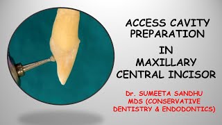 Incisor access opening| Incisor access cavity RCT| Easy endodontics for maxillary incisor