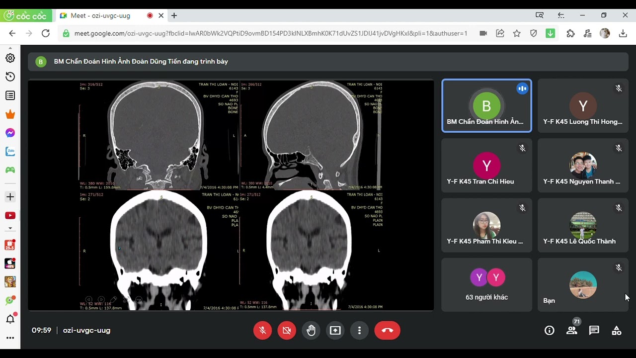 XQuang CT Sọ Não | Chẩn đoán hình ảnh Ctump