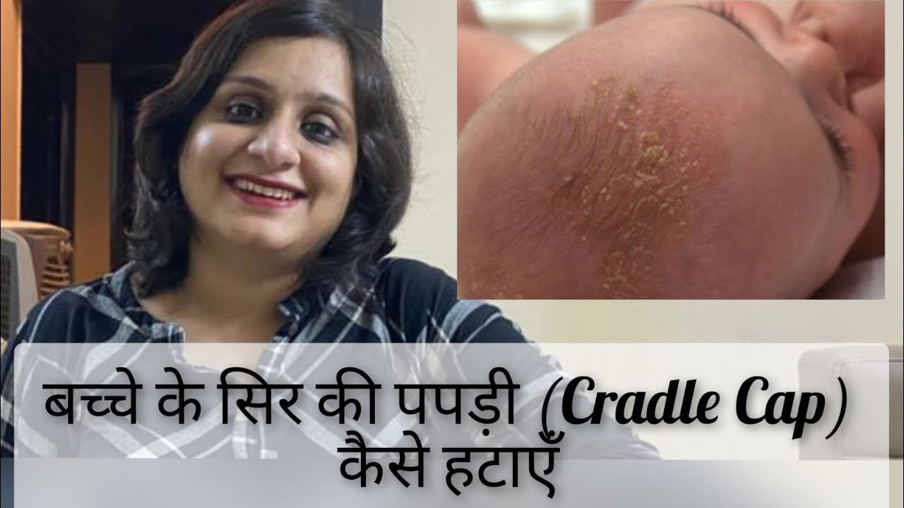 How to remove Cradle Cap in babies बच्चे के सिर की पपड़ी (Cradle Cap