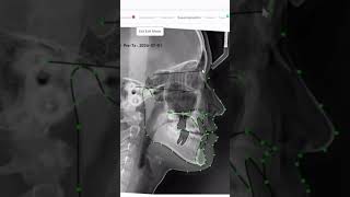 Did you knowIn WebCeph, you can edit landmarks directly in the Superimposition tab #Cephalometry