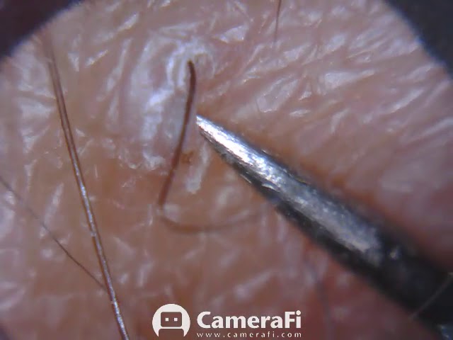 Itchy Ingrown Hair Removed Pimplepoppingvideos Net