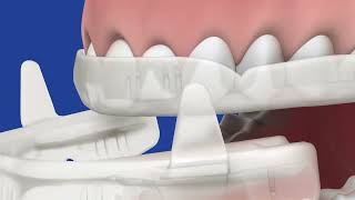 SleepRight Snore Aid - How it Works