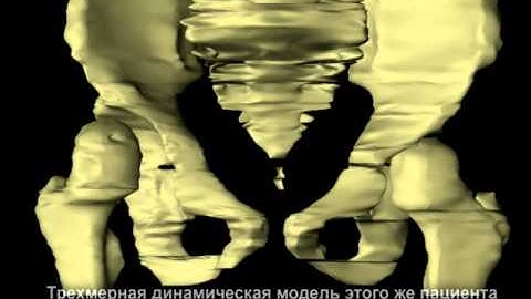 Acetabular angle and Salter osteotomy 3D / ацетабулярный угол и операция Солтера