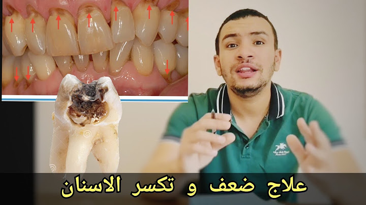 اسباب ضعف الاسنان و تكسرها و تسوسها | 5 اسباب و حلولها