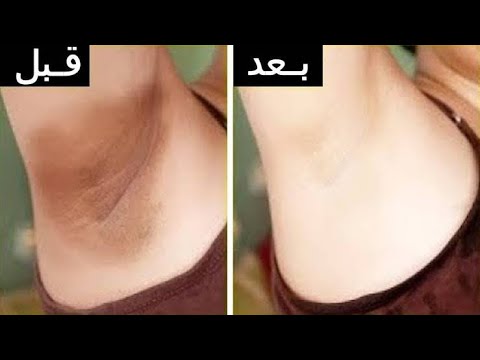 بحاجتين بس هتخلى البكيني و الاندرام و الركبة و الكوع و مفاصل اليد ابيض اشطا