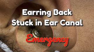 A Little Girl with an Ear Ring Back Stuck in the Ear Canal