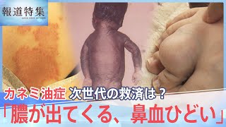 黒い赤ちゃん”その後も・・・カネミ油症、次世代が訴える症状【報道