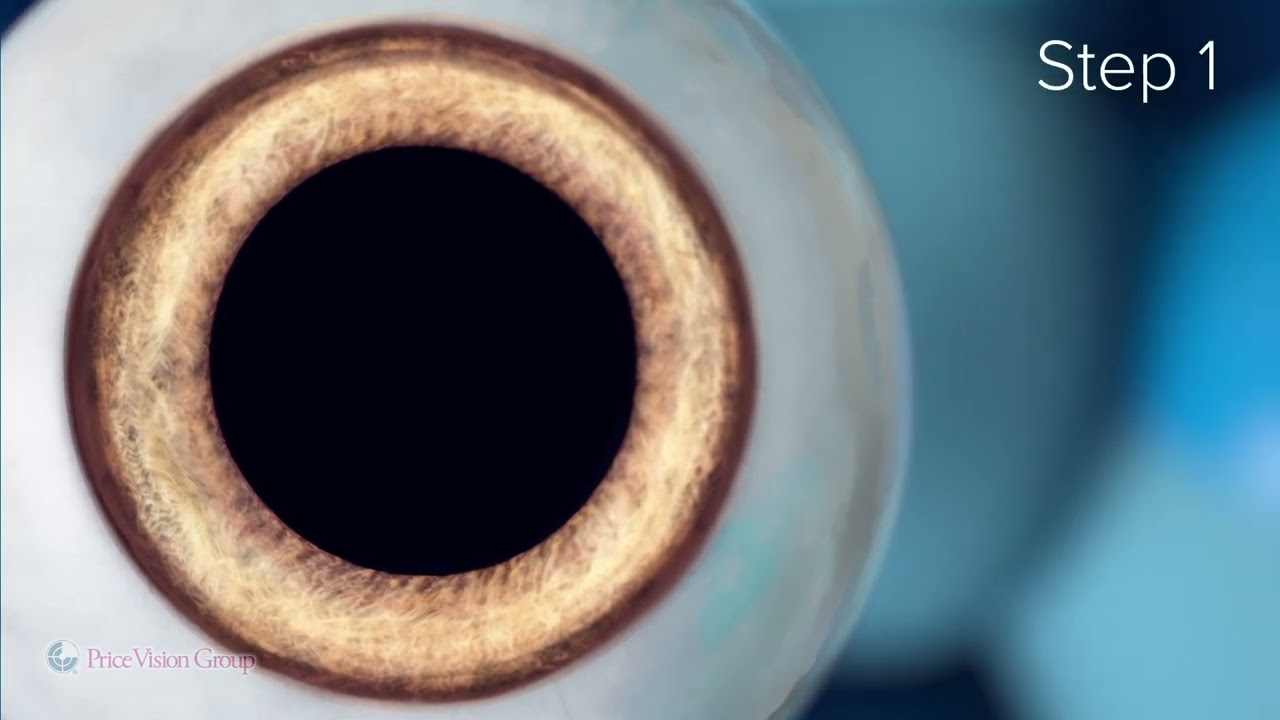 evo-visian-icl-price-vision-group-youtube