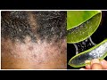 Disadvantages Of Using Aloe Vera for Hair treatment/My Bad Aloe Vera Hair Treatment Experience