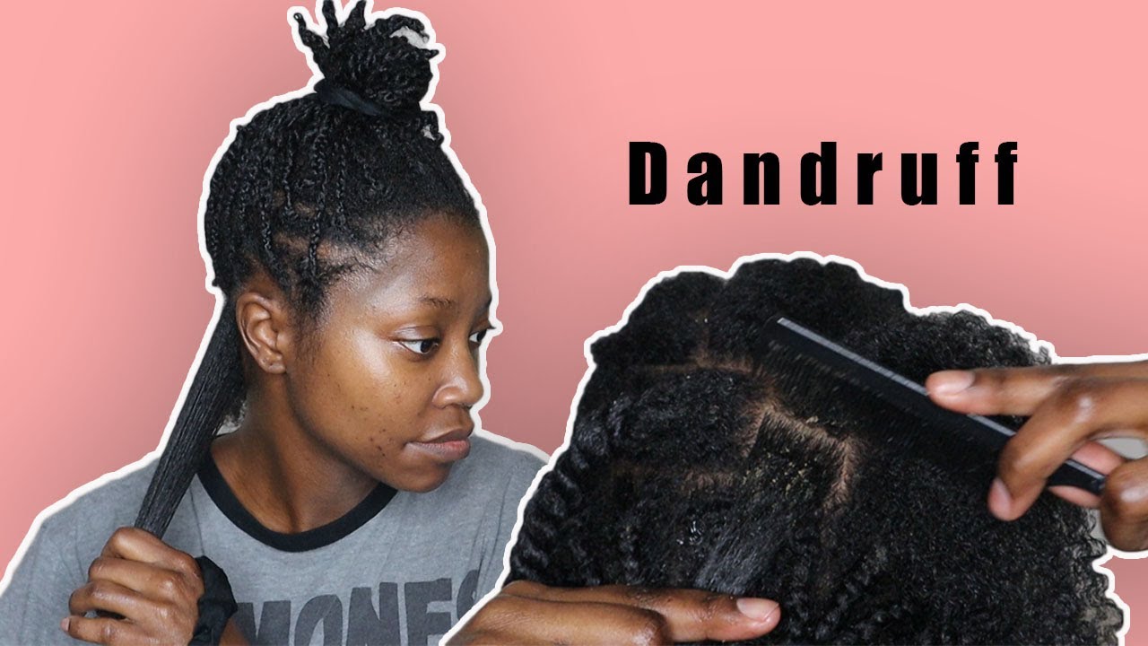Scratching Out My Dandruff And Taking Down My One Month Old Braids Keke J YouTube