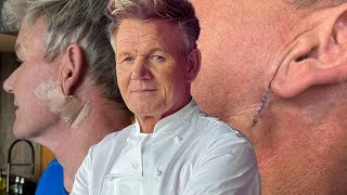 Famous Gordon Ramsay Undergoes Cancer Treatments! Net Worth