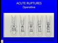 Acute Achilles Tendon Rupture: Instructional Lecture and Debates