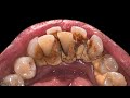 Crowding Teeth Will Increase Tartar Buildup | Scaling