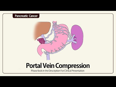 Portal Vein Compression