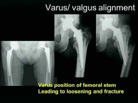 Biomechanics of the Hip Joint