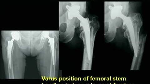 Biomechanics of the Hip Joint