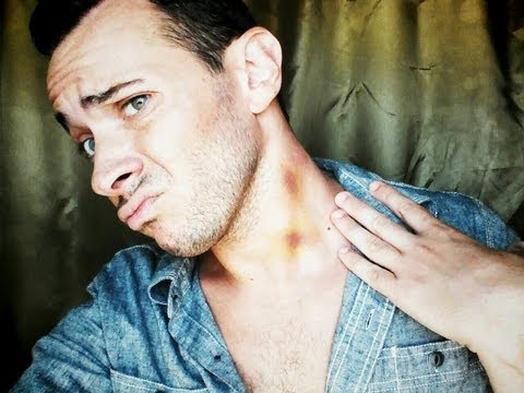 How to Remove a Hickey FAST | Tip #94