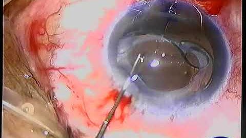 IOL re-fixation + pupil cerclage