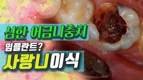 심한 어금니충치 임플란트 대신 사랑니이식 자가치아이식/치아재식술