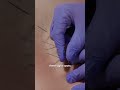 How Dry Needling Helps Release Muscle Knots